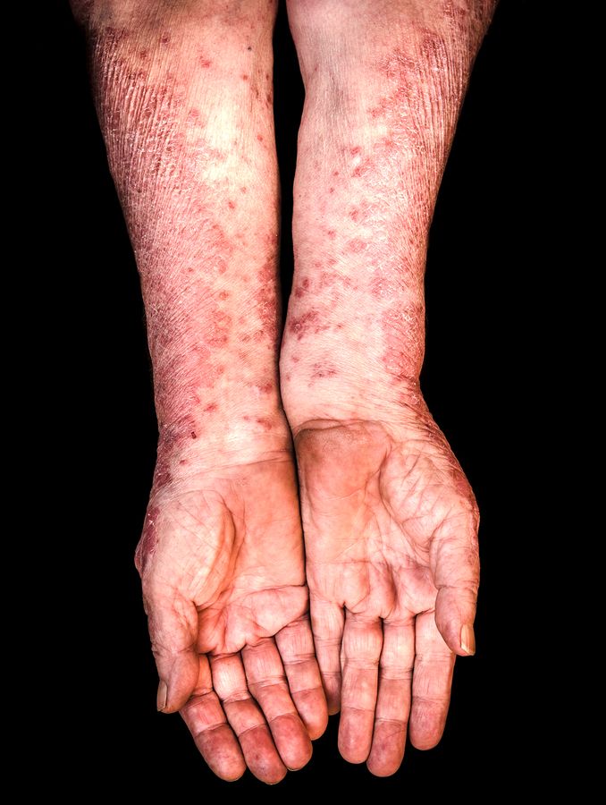 bigstock Hands With Psoriasis 101391299