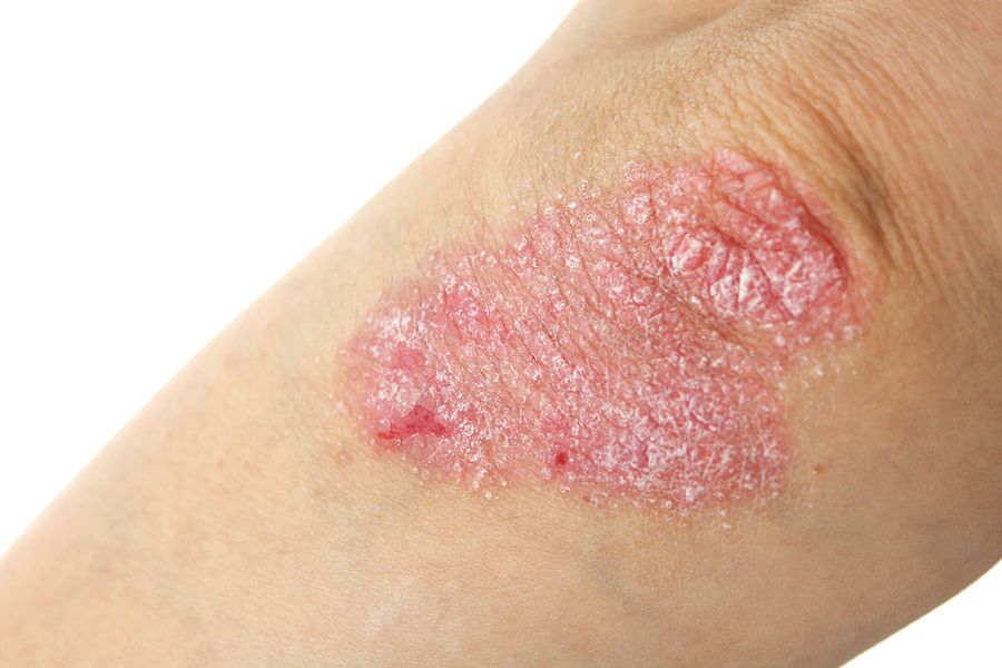 bigstock Psoriasis 68407369