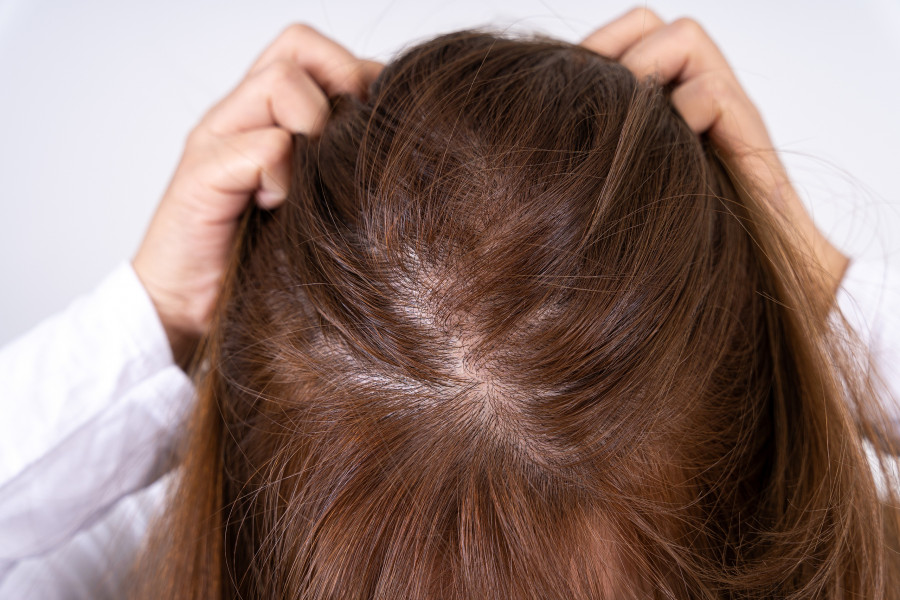Woman-Hair-Loss-mallia-trixoptosi-araiosi