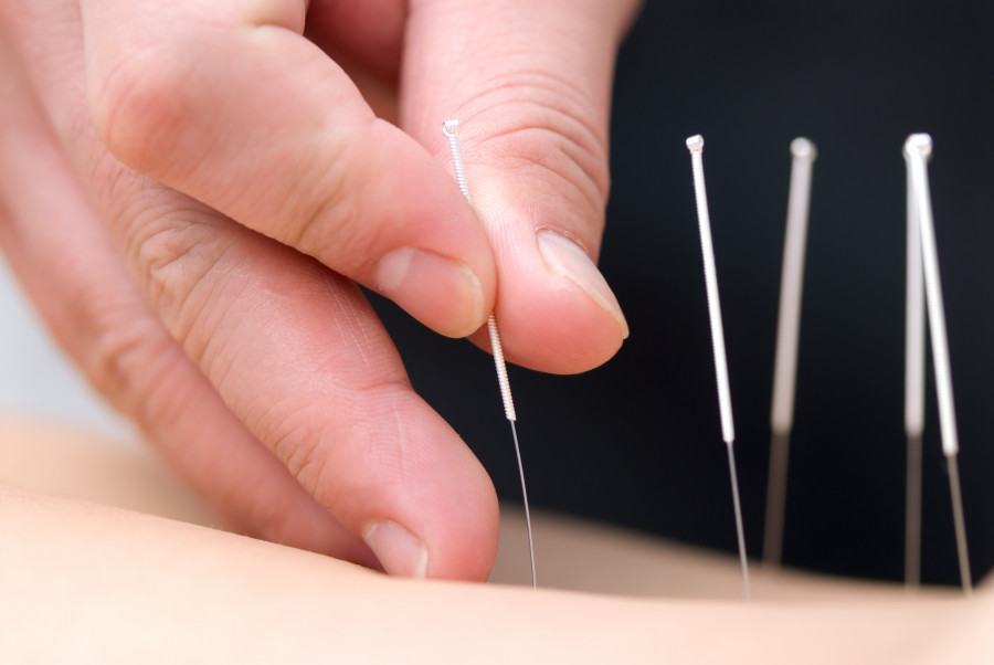 acupuncture-belonismos-velonismos