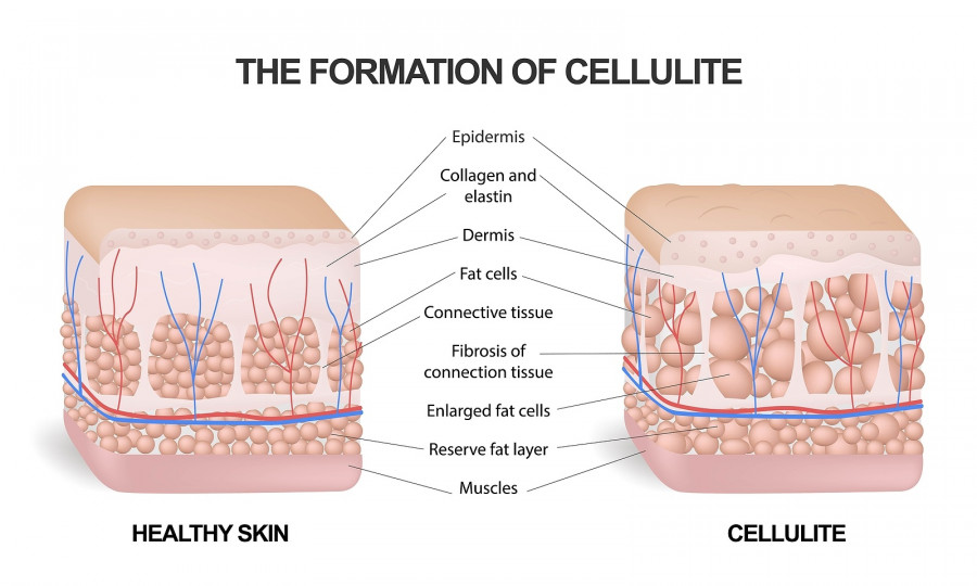 The Formation Of Cellulite