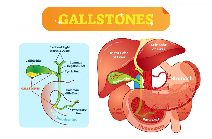 Gallstones