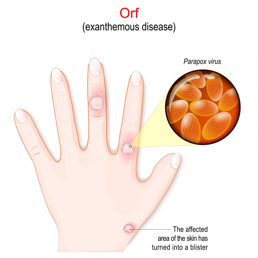 Orf. Exanthemous Disease. Human's Hand With The Affected Area