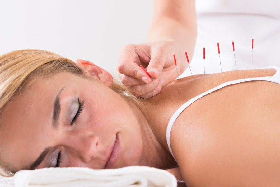 Therapist Performing Acupuncture Therapy On Woman's Back