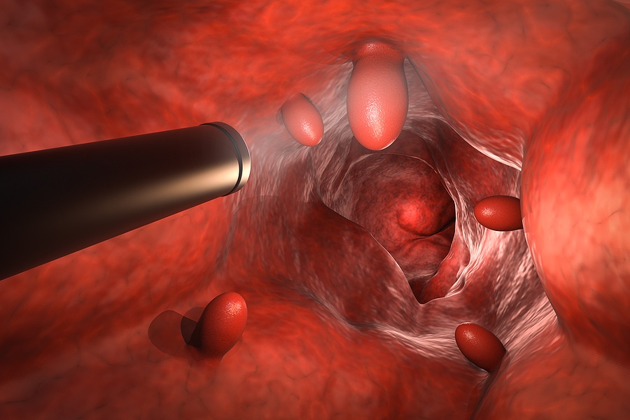 Colonoscopy Technology Concept With 3d Rendering Endoscope Insid