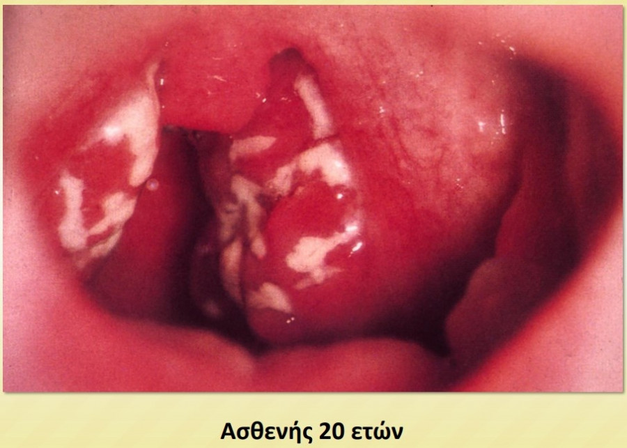 strep-2.jpg