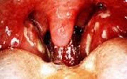 strep-6.jpg