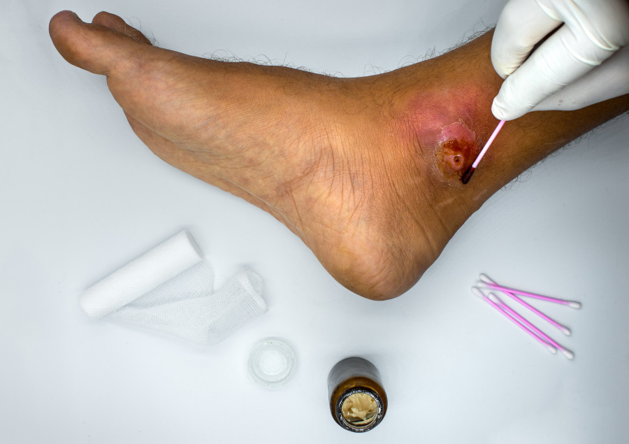 Doctor Applying Medicine To Infected Wound foot