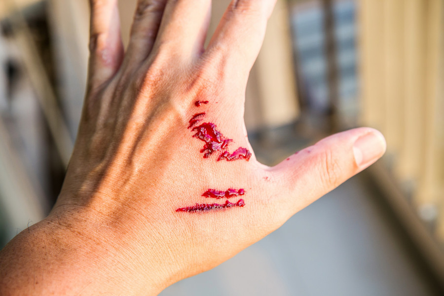 Dog Bite Wound And Blood On Hand. Infection
