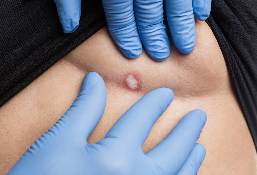 Plastic Surgeon Hands Checking Mole Removal Under Breast