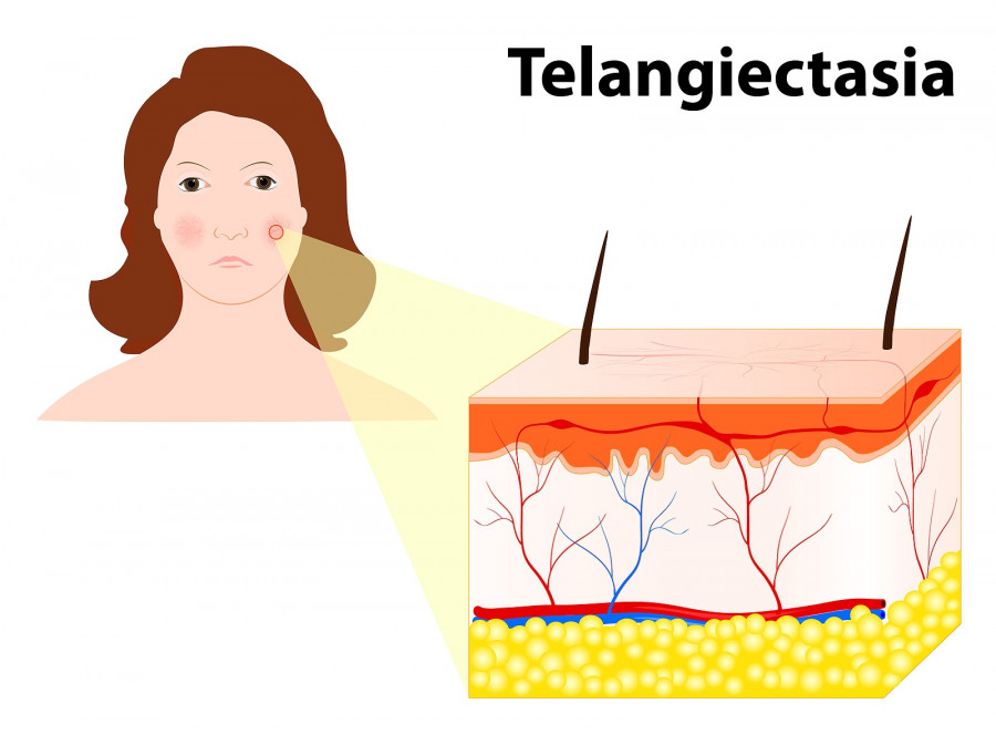 Telangiectasias. Spider Veins Or Angioectasias