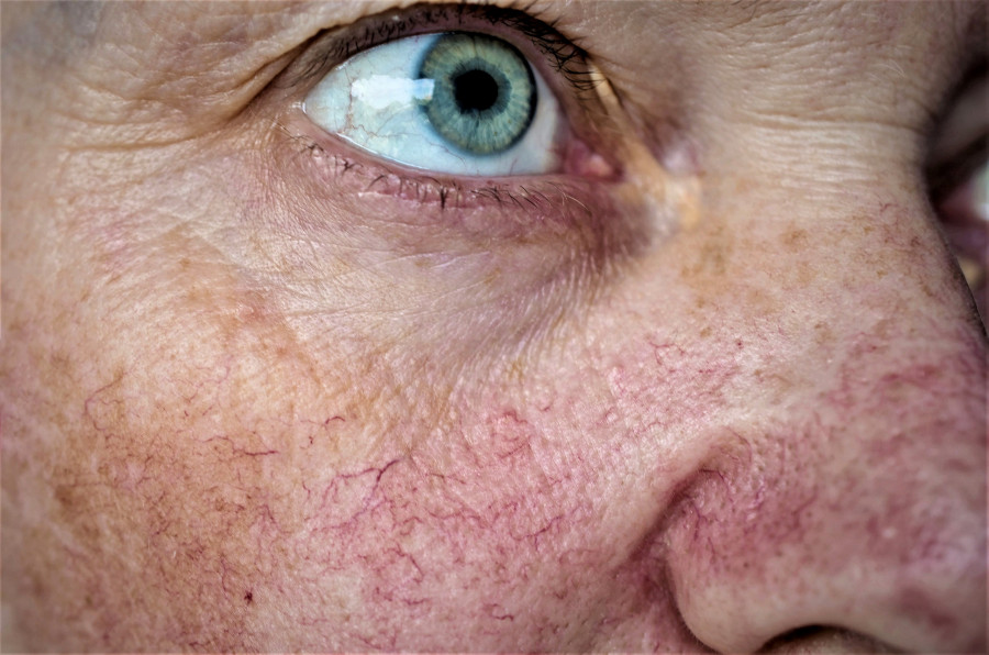 Woman Face Skin With Vascular Stars And Couperose