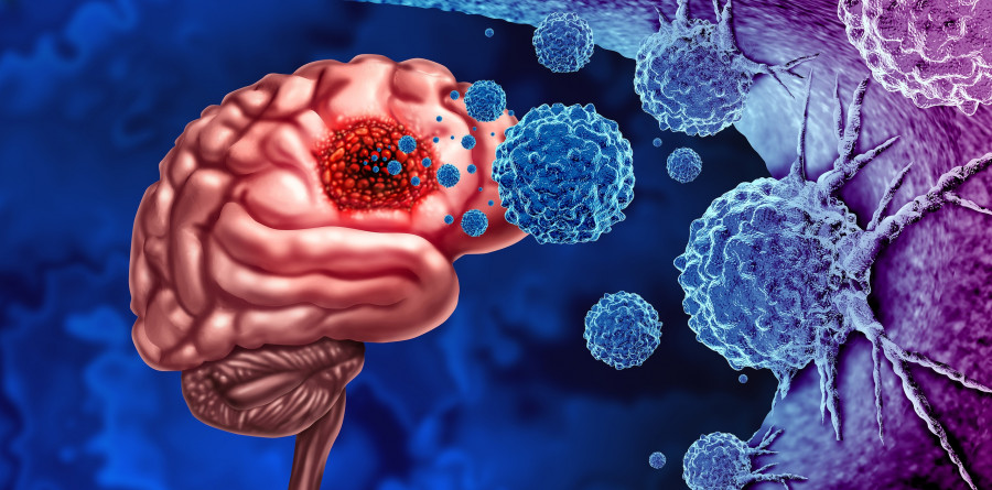 Glioma Cancer Tumor in Brain