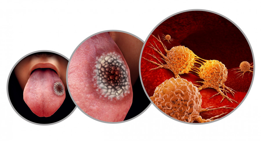 Tongue Cancer Medical Concept Or Squamous Cell Carcinoma