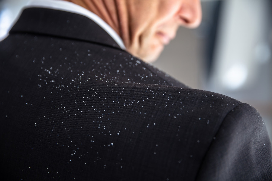 Close-up Of A Businessperson With Dandruff On His Shoulder