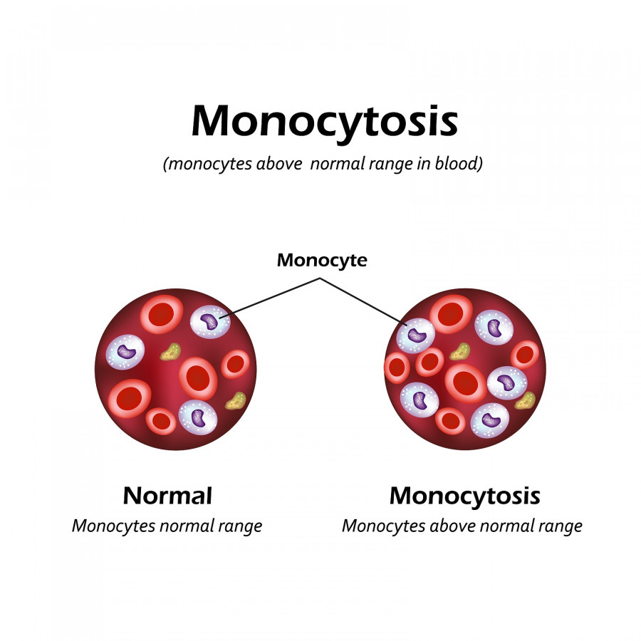 Monocytes Above The Normal Range In The Blood. Monocytosis.