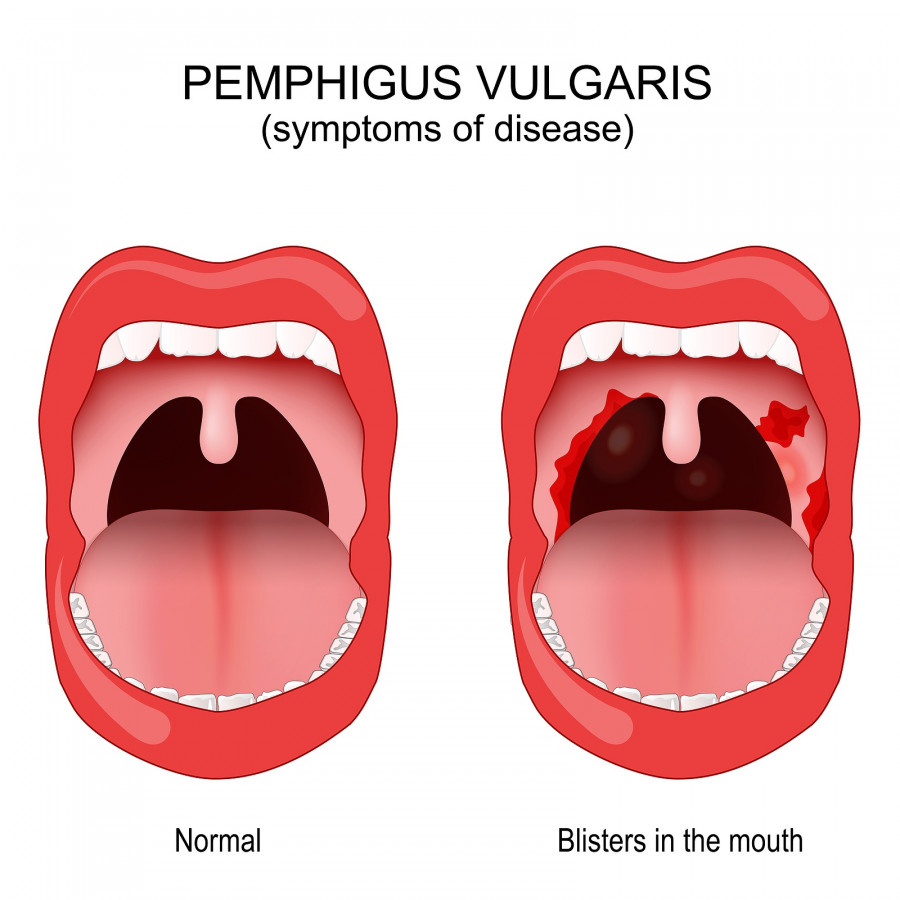 Pemphigus Vulgaris. Problem With The Immune System