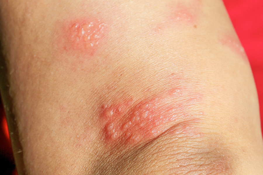 Skin Rash