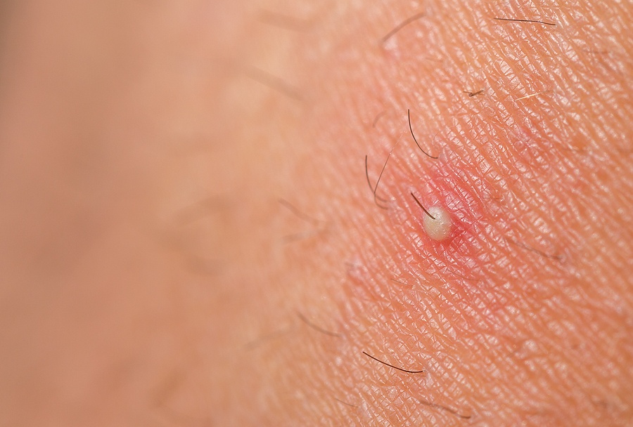 skin with ingrown hair pimple boil
