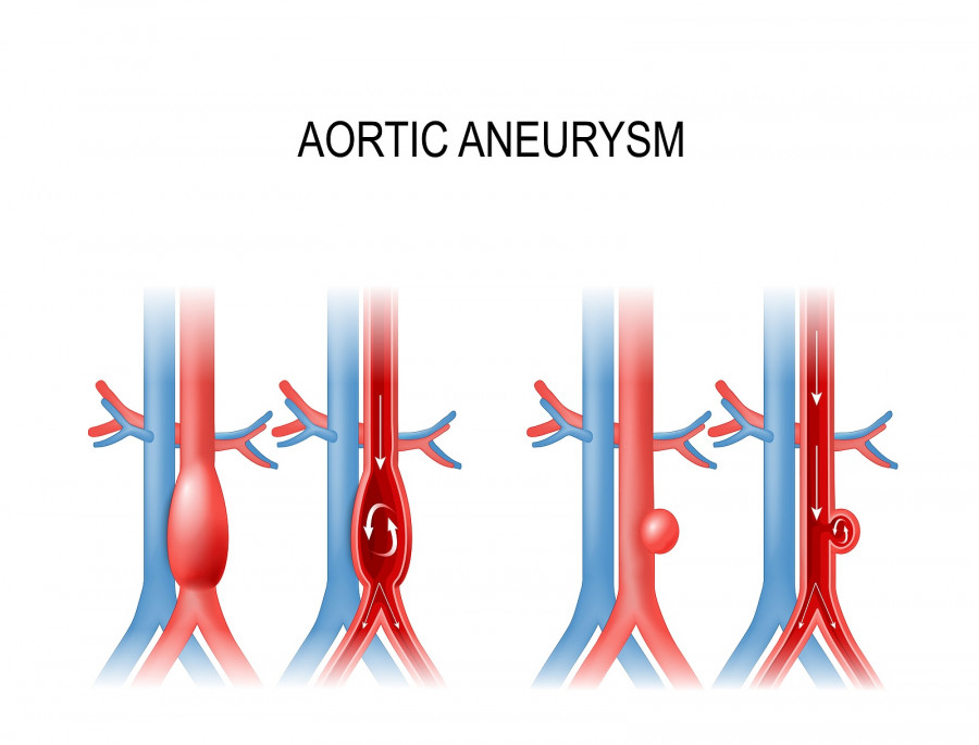 Abdominal Aortic Aneurysm