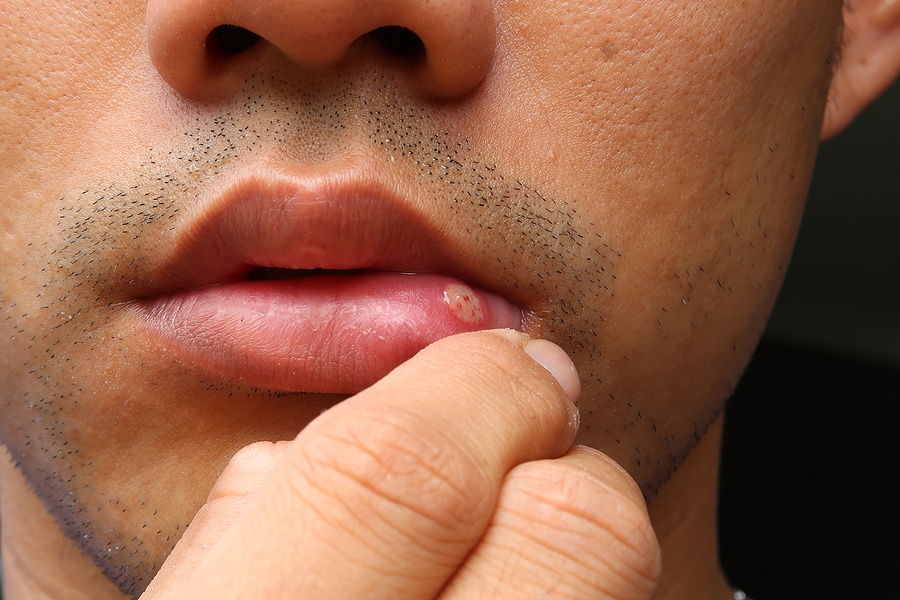 Aphthous Stomatitis