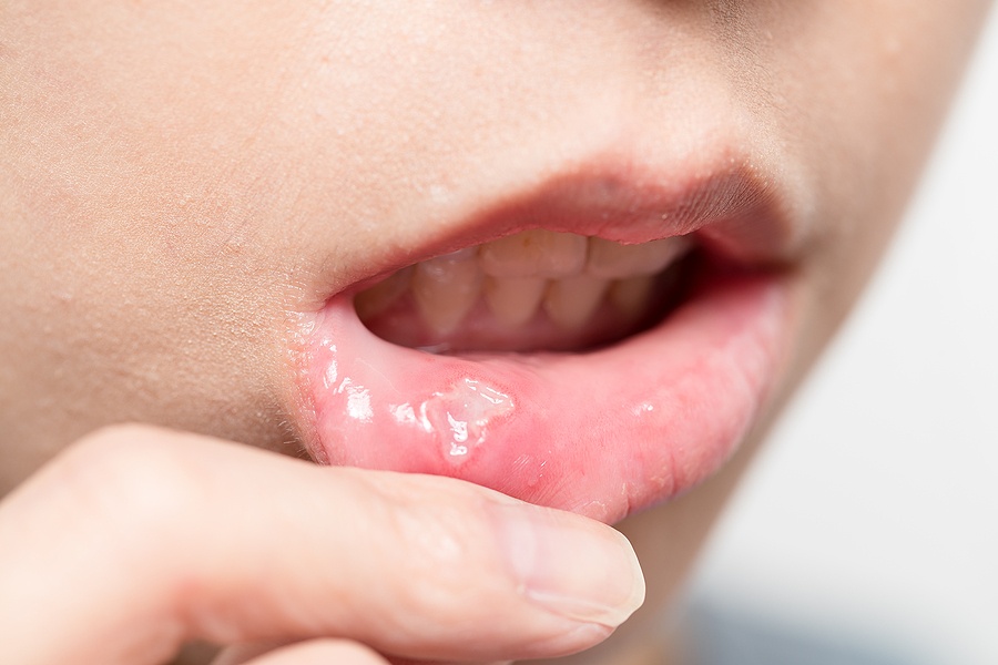 canker sore