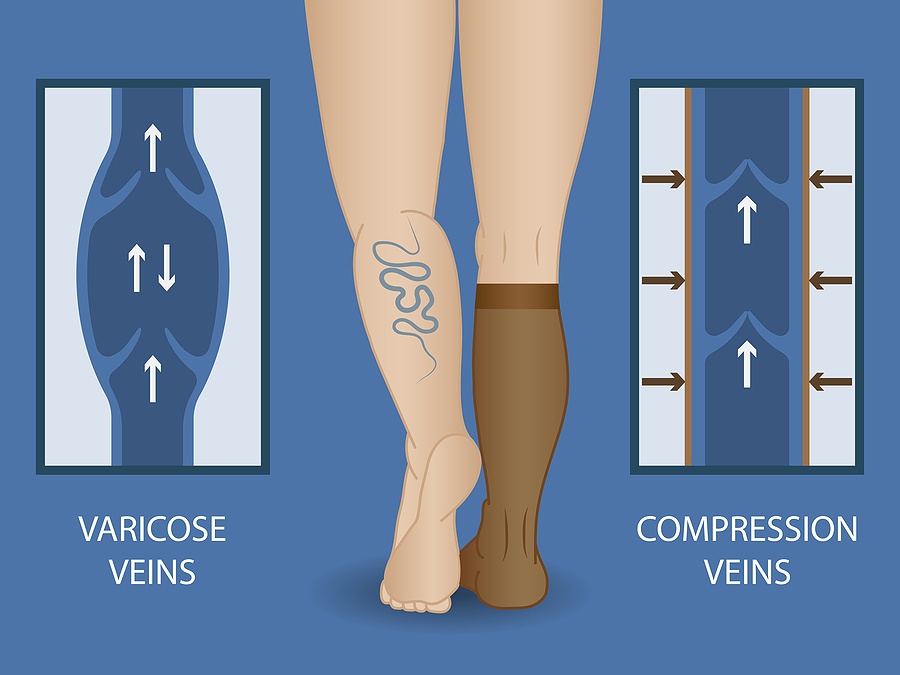 Medical Compression Socks For The Treatment Of Varicose Veins