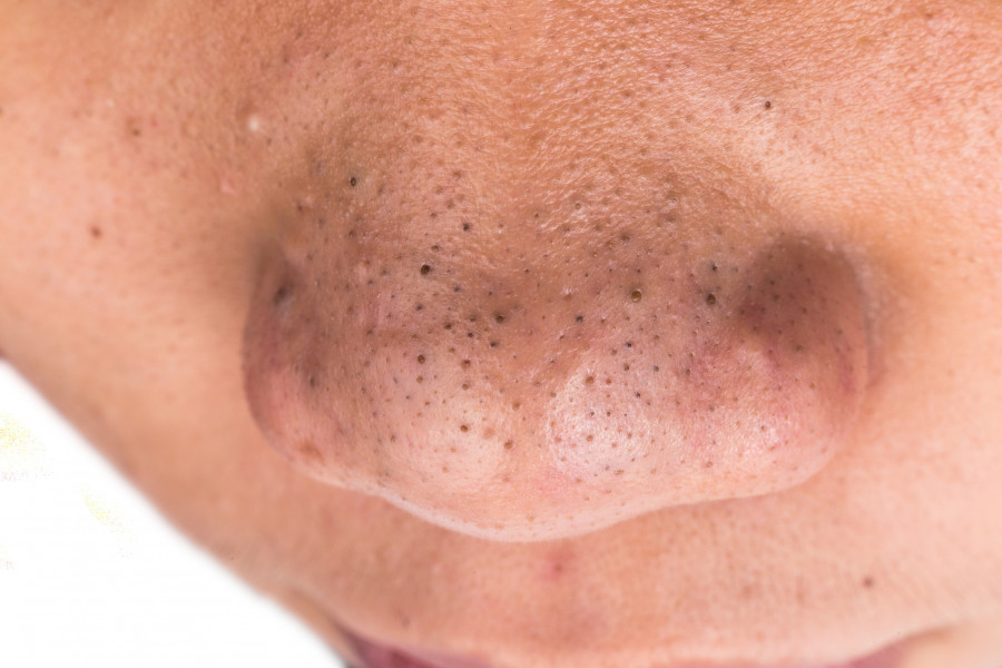 Close up on pimple blackheads on the nose of a teenager