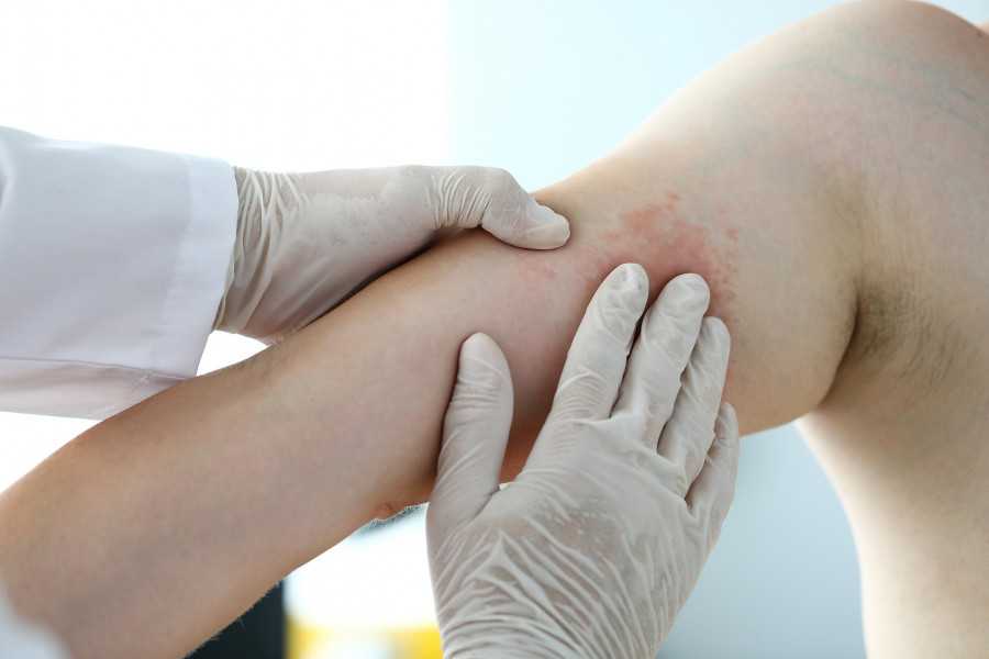 Focus On Poor Suffering Patient Skin. Hand In Glove Of Professio