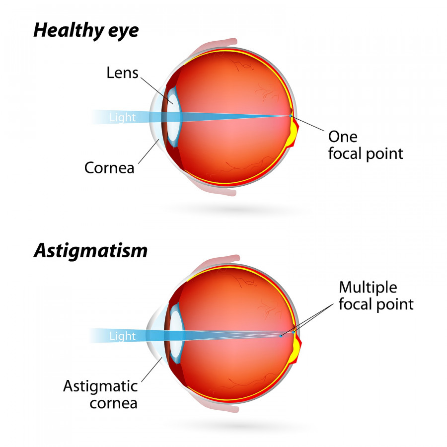 Astigmatism