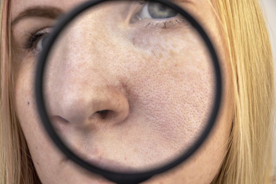 Expanded Pores, Black Spots, Acne, Rosacea Close-up On The Nose.
