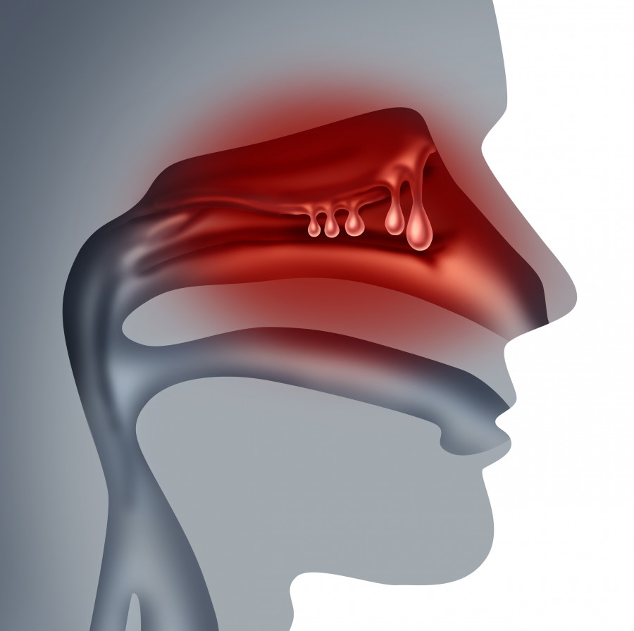Nasal polyps