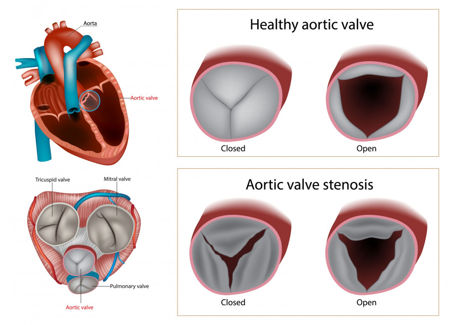 Healthy Aortic Valve Or Aortic Valve Stenosis