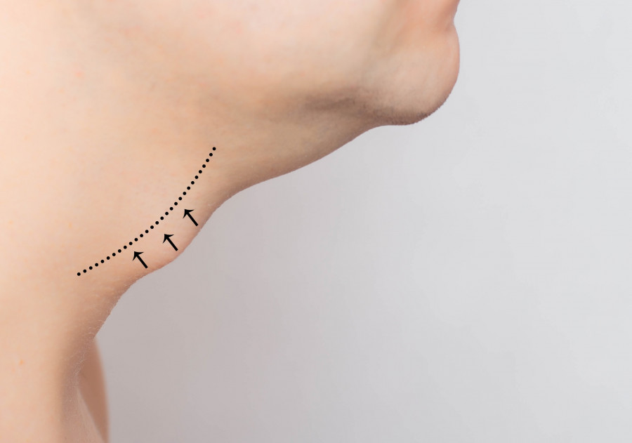 Adams Apple, Reduction And Removal