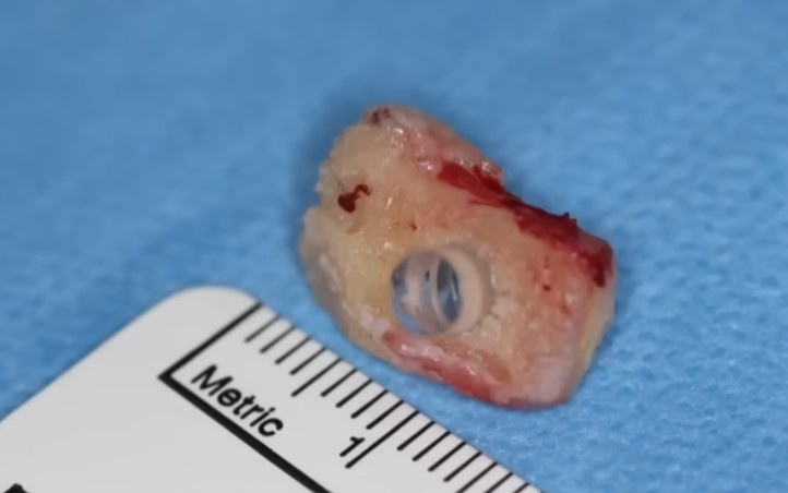 tooth-in-eye.jpg