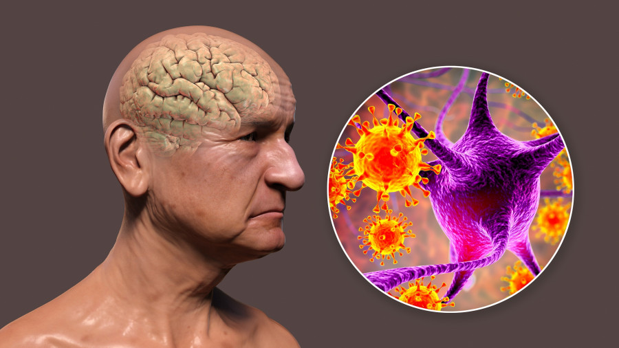 Infectious Etiology Of Dementia