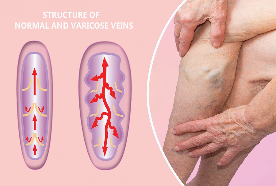 Varicose Veins