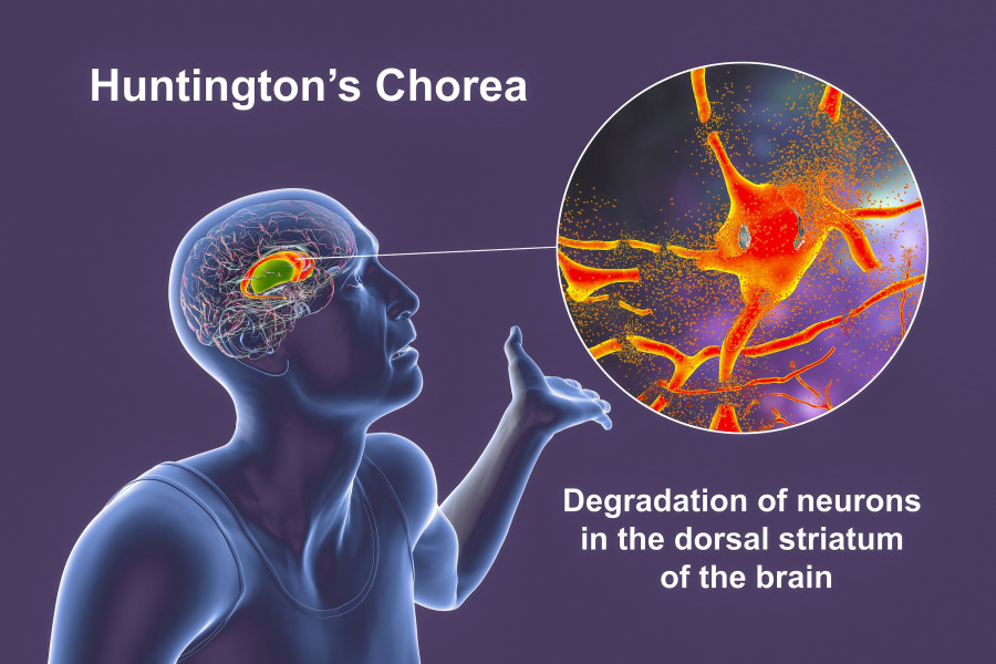 Huntingtons disease