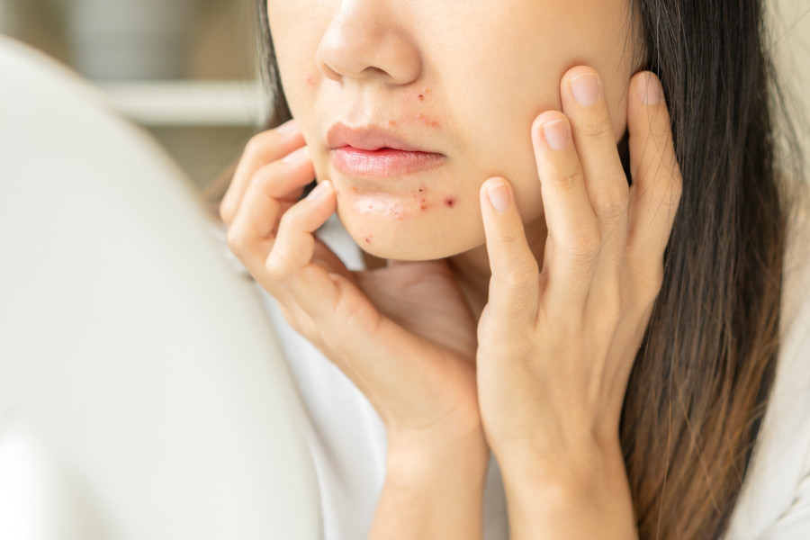 Beauty care, skin problem by acne treatment