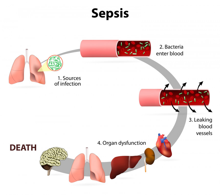 Sepsis  septicaemia 