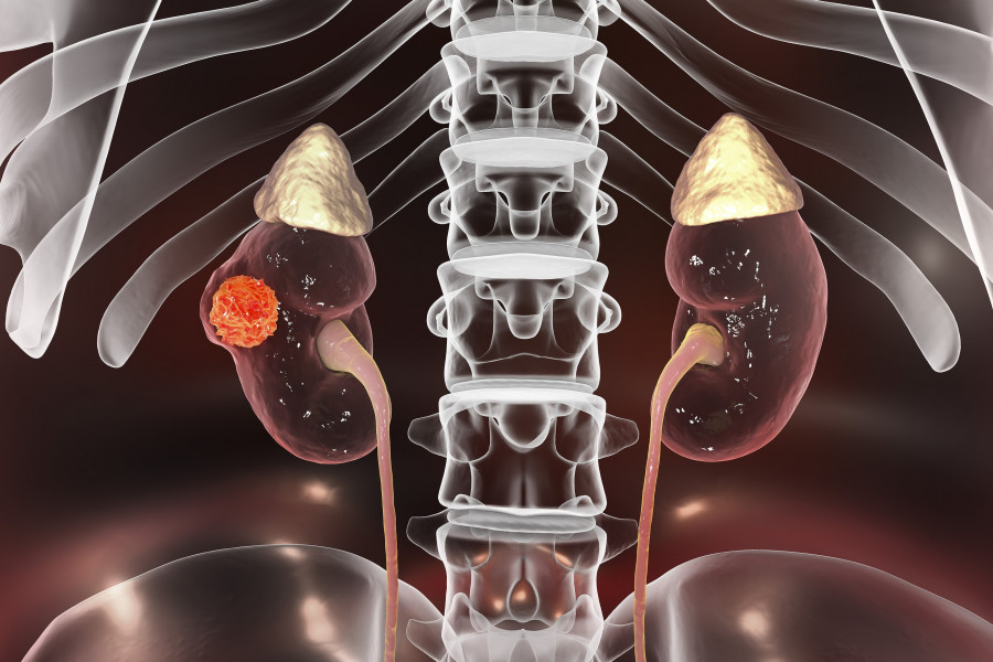Kidney Cancer