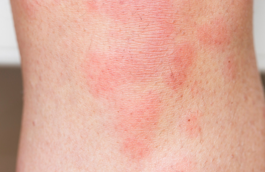 Hives On Skin, Red Urticaria Rash