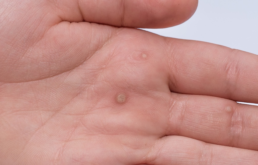 flat wart