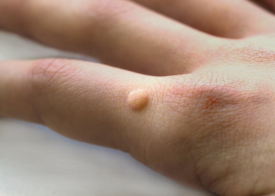 Common Wart Verruca Vulgaris A Flat Wart