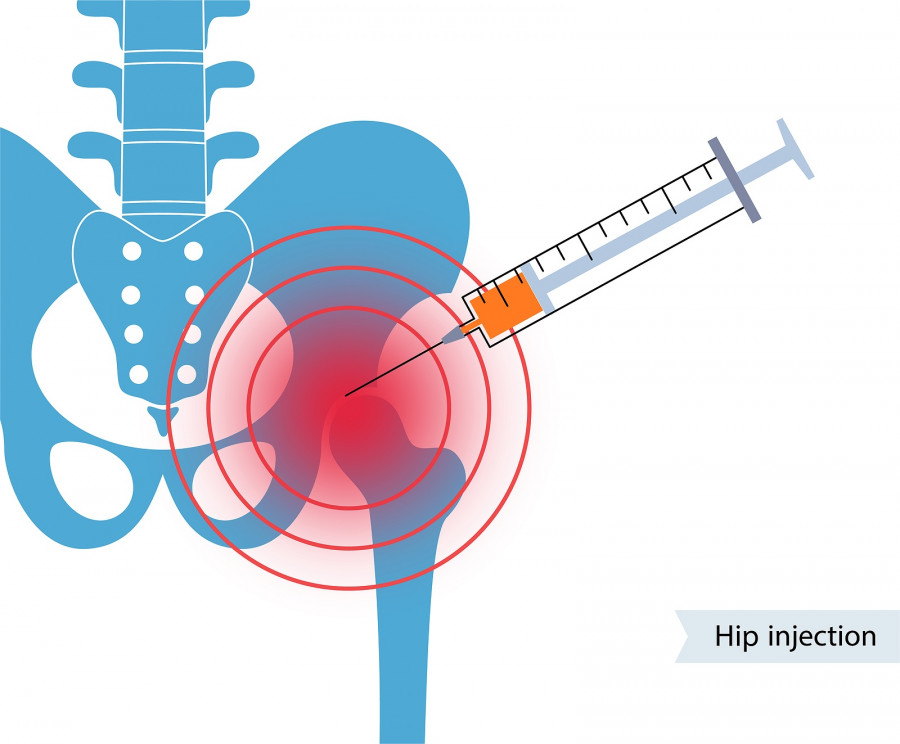 Hip Joint Cortisone Injection