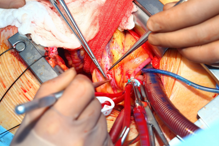 Heart Surgery. Coronary Artery Bypass Surgery