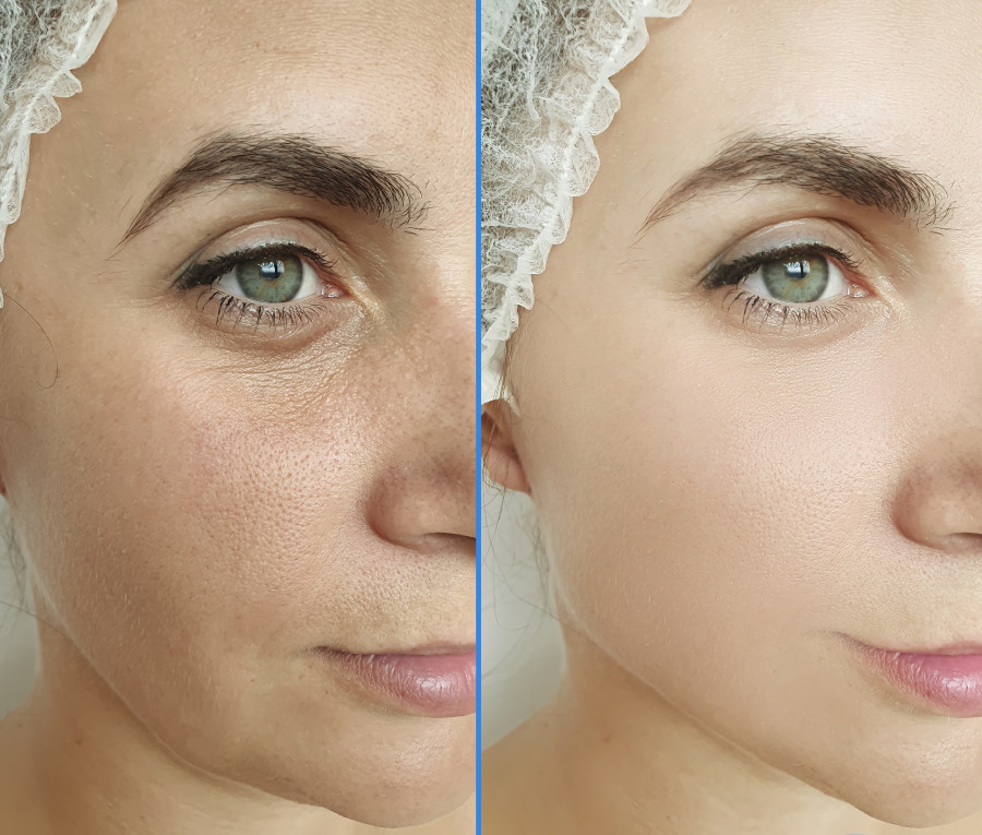 Woman Face Wrinkles Before And After Treatment