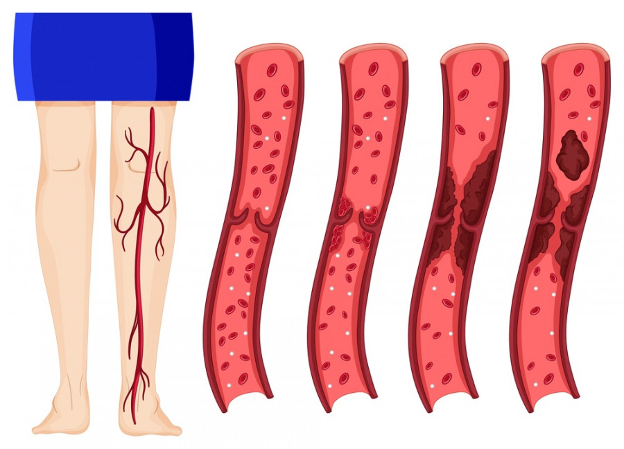 Blood clot in human legs (deep vein thrombosis)