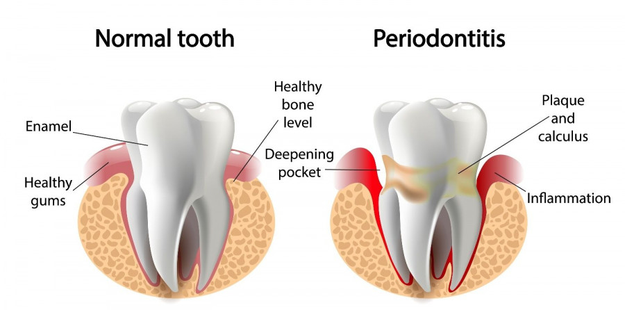 Περιοδοντίτιδα