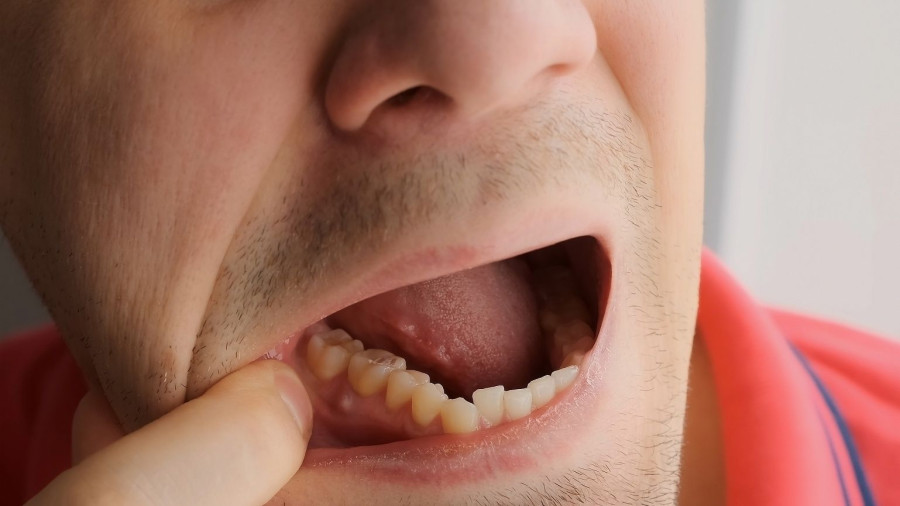 Οδοντικό απόστημα